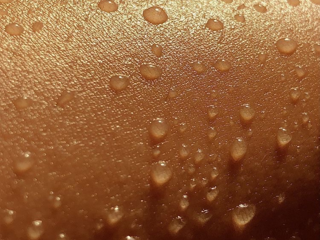 What Is Hyperhidrosis?