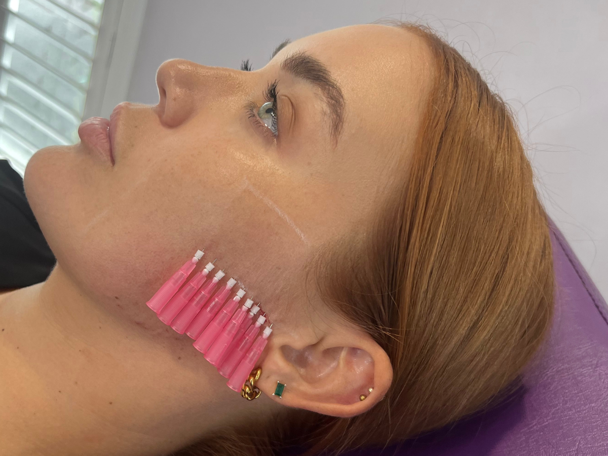 PDO Threads & their remarkable anti-aging benefits