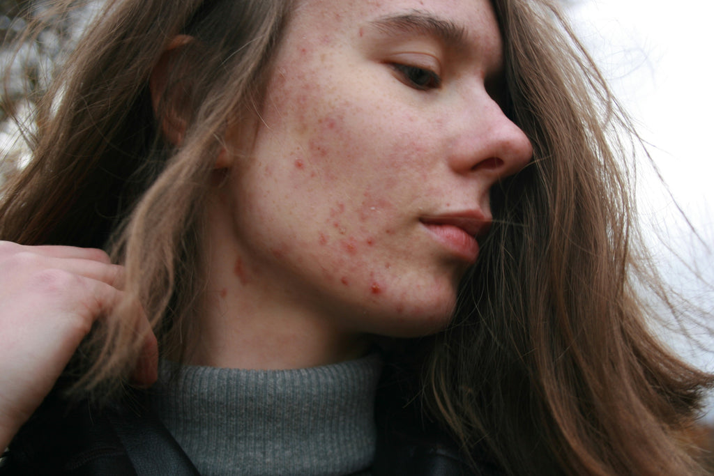 Let’s Talk About The Emotional Impact of Acne